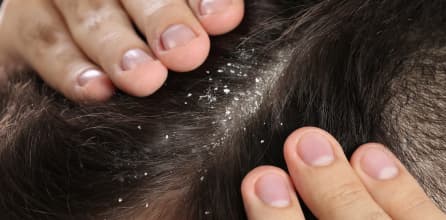 7 Tips Menghilangkan Ketombe Membandel secara Alami dan Permanen